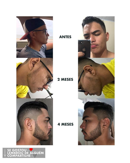 Quero ter barba mas ela n o cresce O que devo fazer Barba