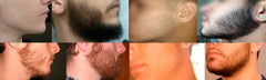 Falha na barba – Tratamentos & Soluções